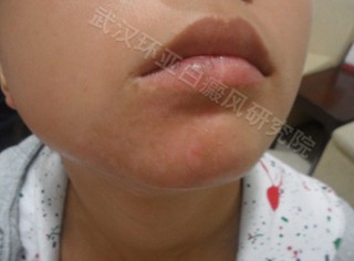 武汉白癜风治疗医院网站