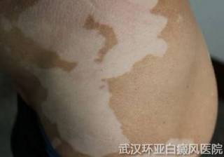 节段型白癜风症状有哪些呢