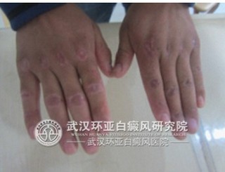 白癜风患者对于饮食有哪些选择